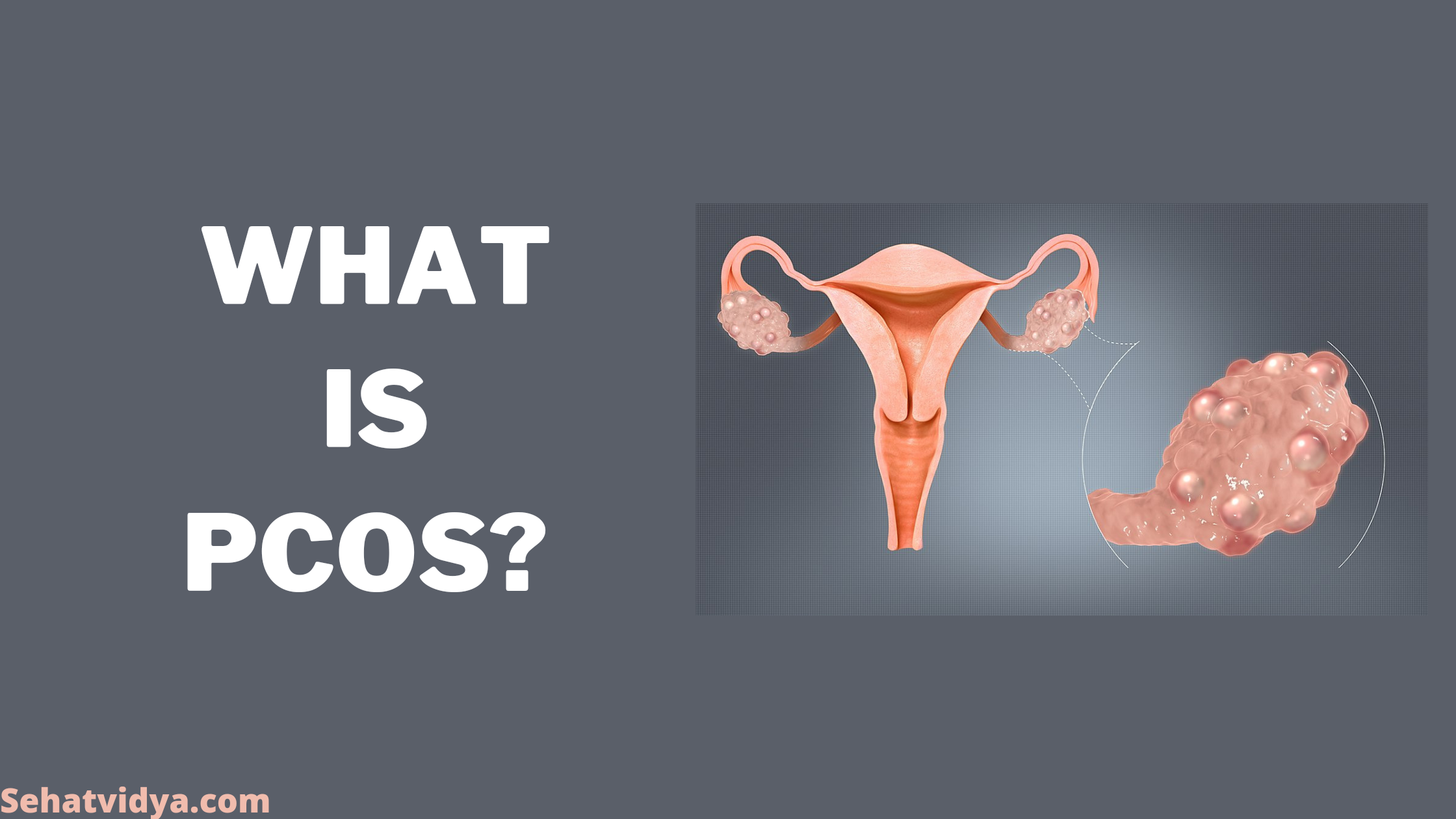  PCOS  