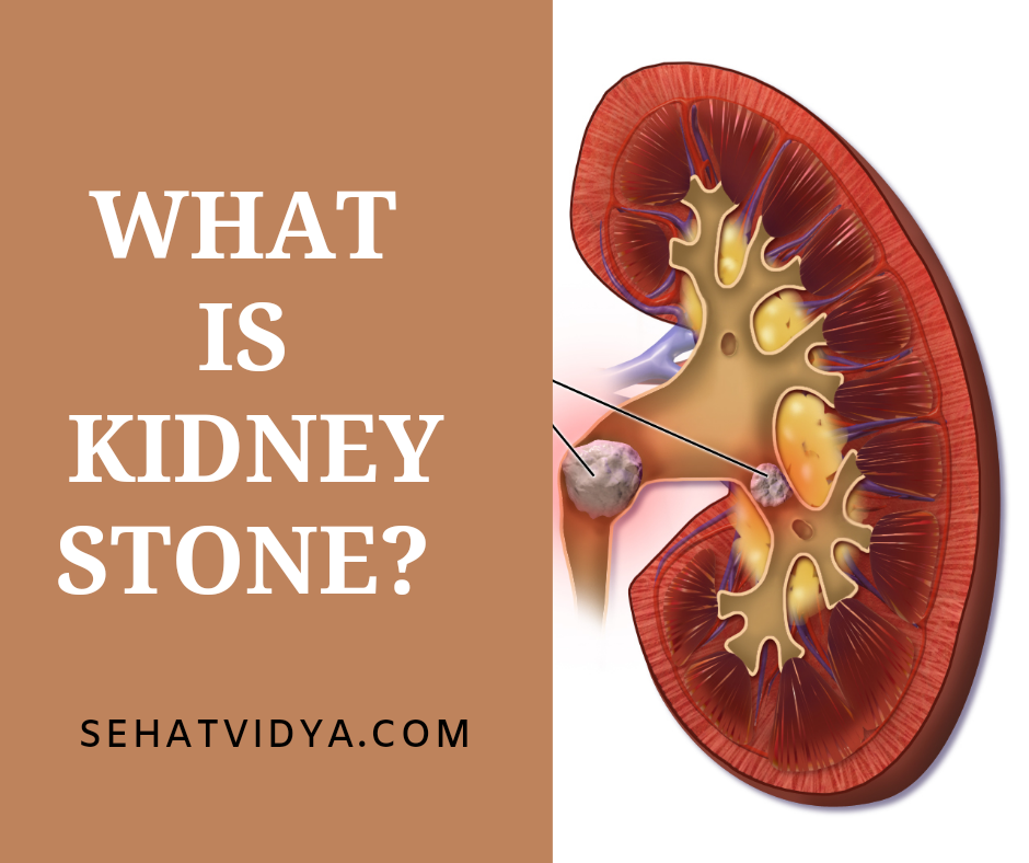 Kidney Stone In Hindi Translation