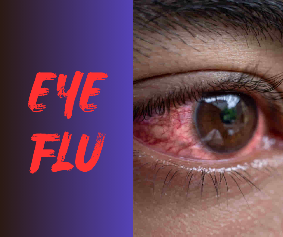 eye-flu-eye-flu